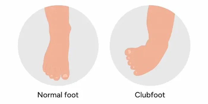 Clubfoot Deformity